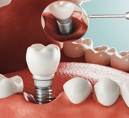 Dental Implant